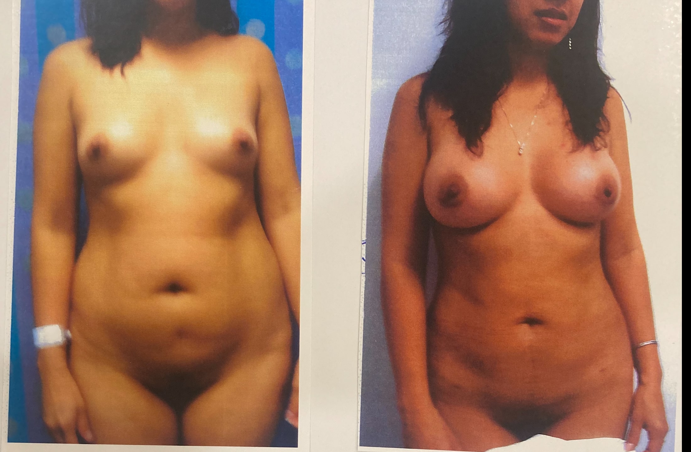 Before and After Image: Lipo 360, Fat Transfer, Breast Augmentation