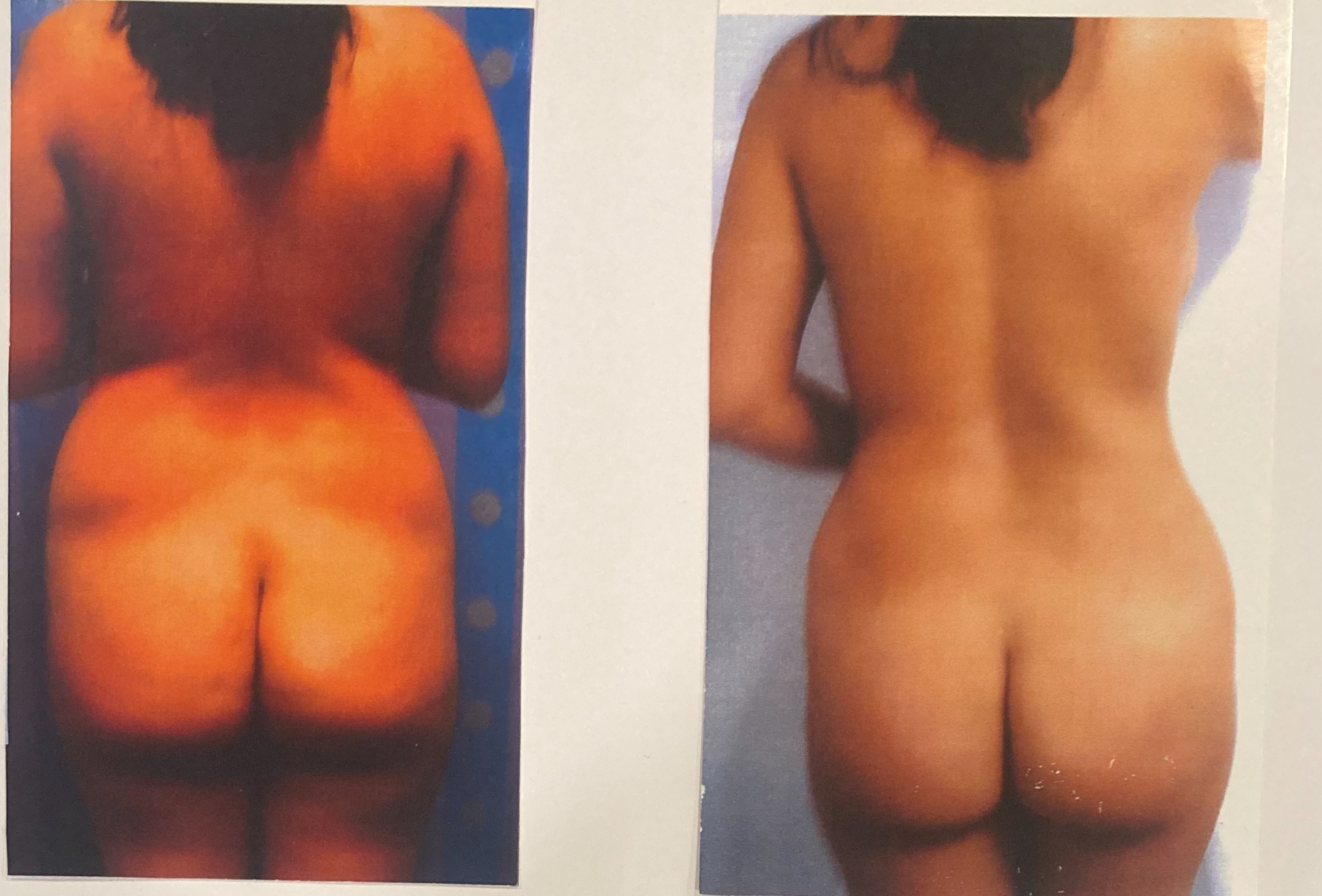 Before and After Image: Lipo 360, Fat Transfer, Breast Augmentation - back