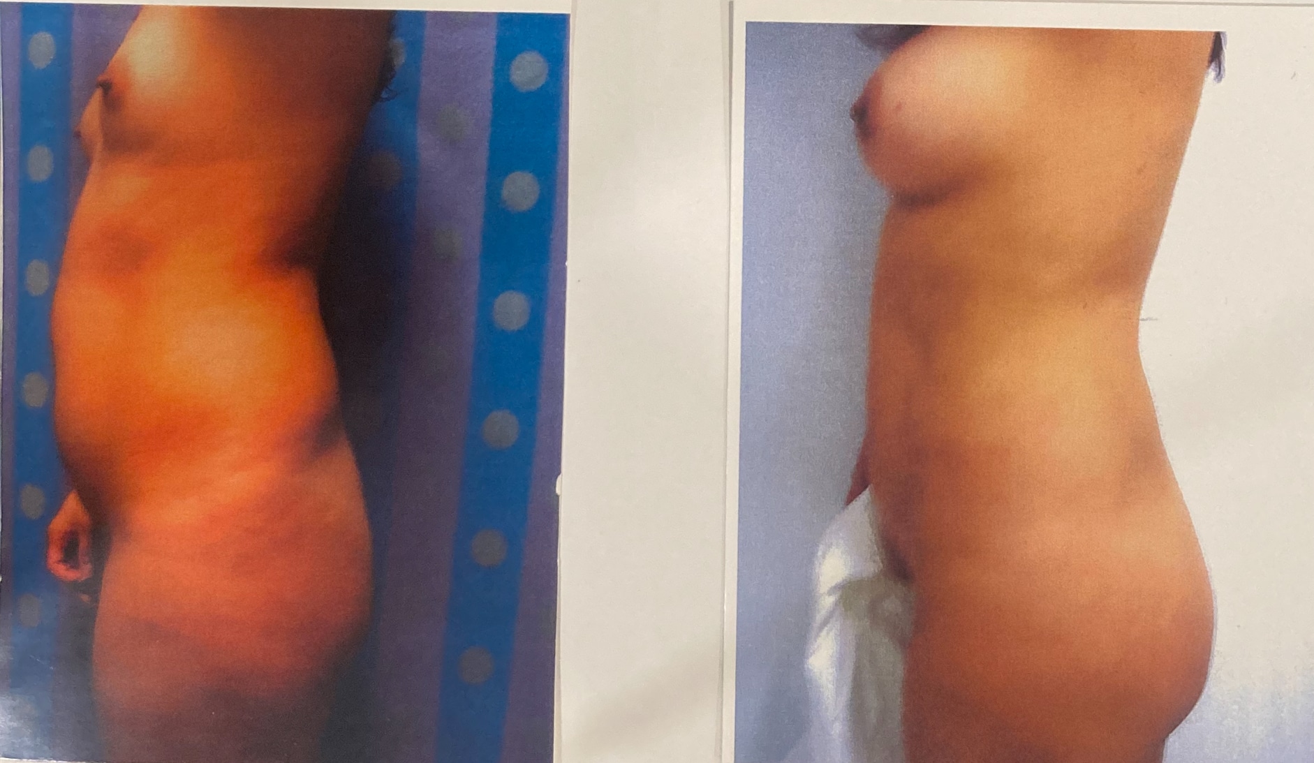 Before and After Image: Lipo 360, Fat Transfer, Breast Augmentation - left-side