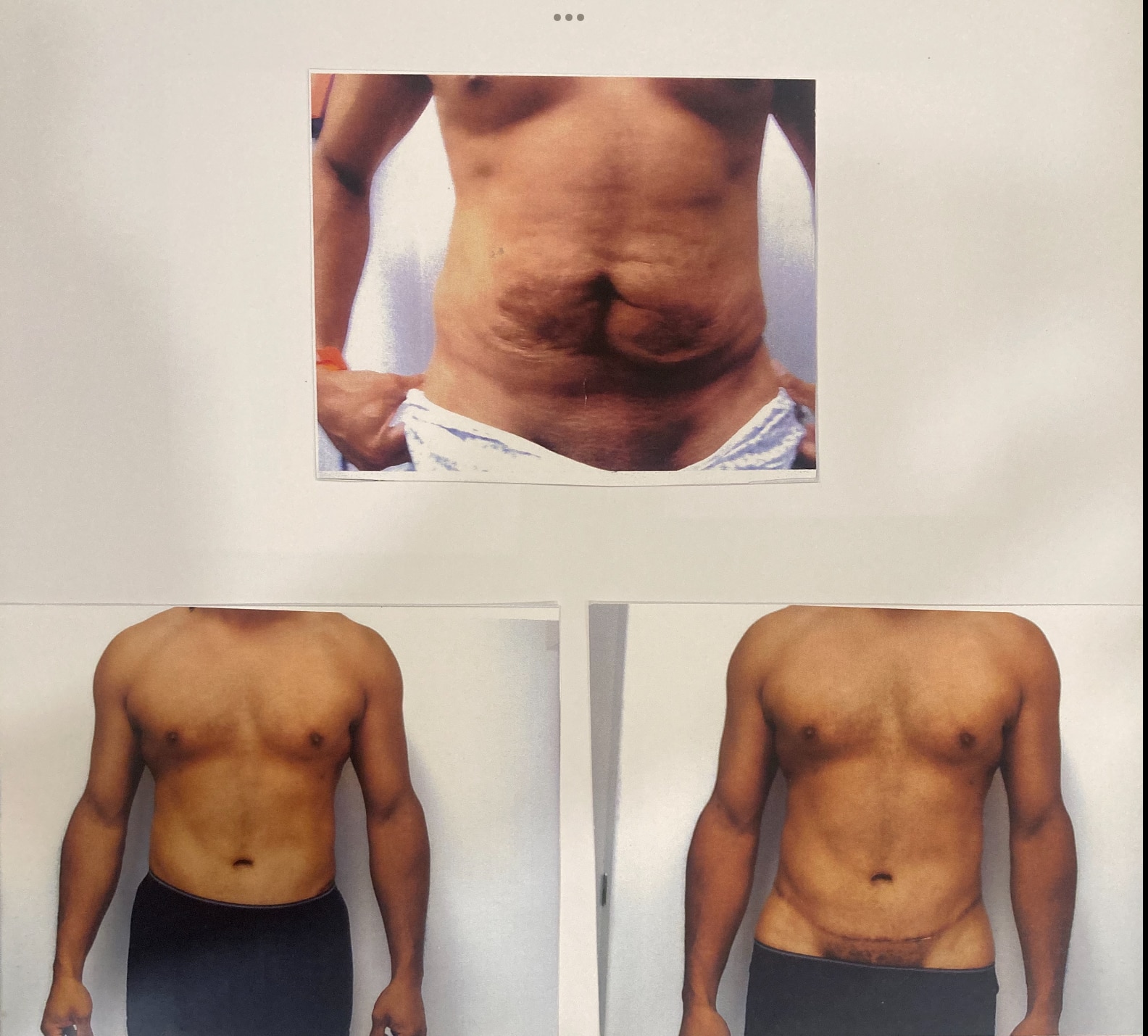 Before and After Image: Abdominoplasty - front