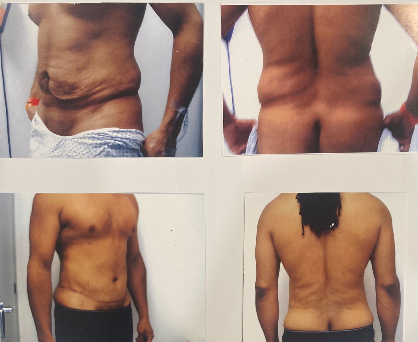 Before and After Image: Abdominoplasty - front