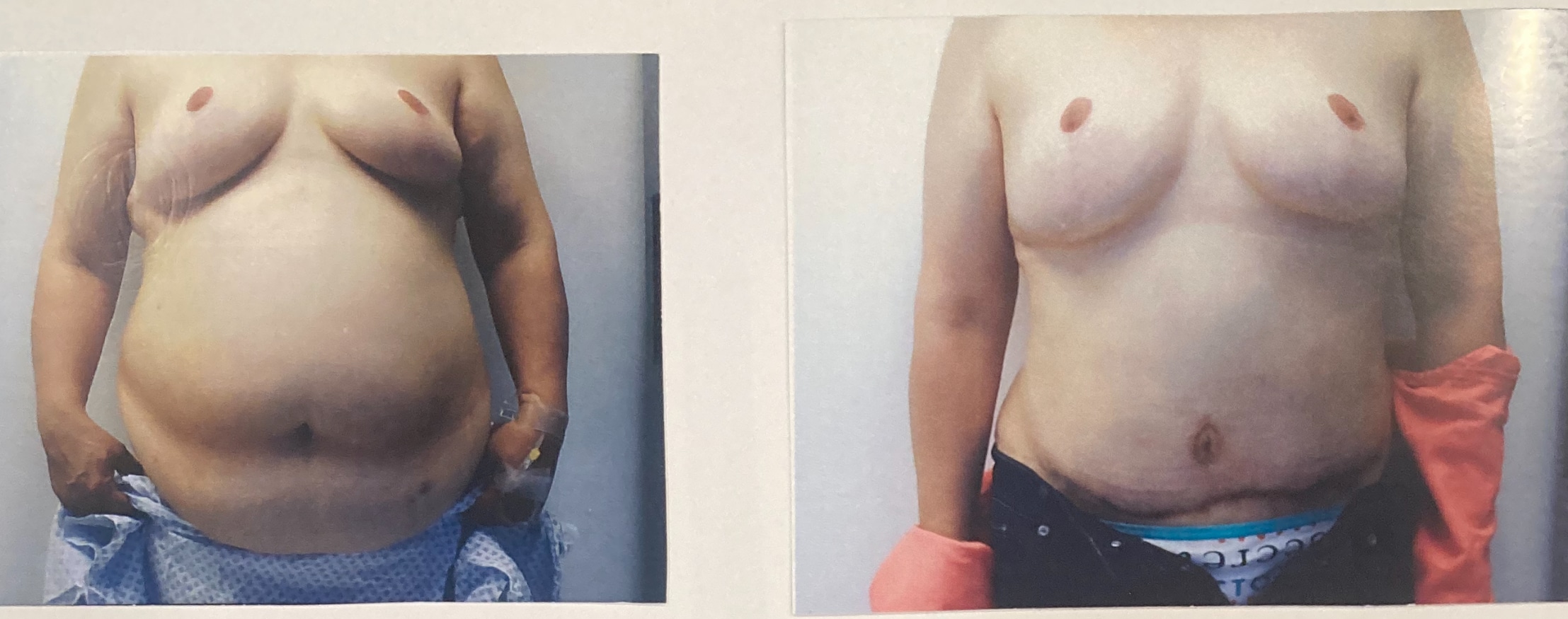 Before and After Image: Abdominoplasty with Liposuction - front