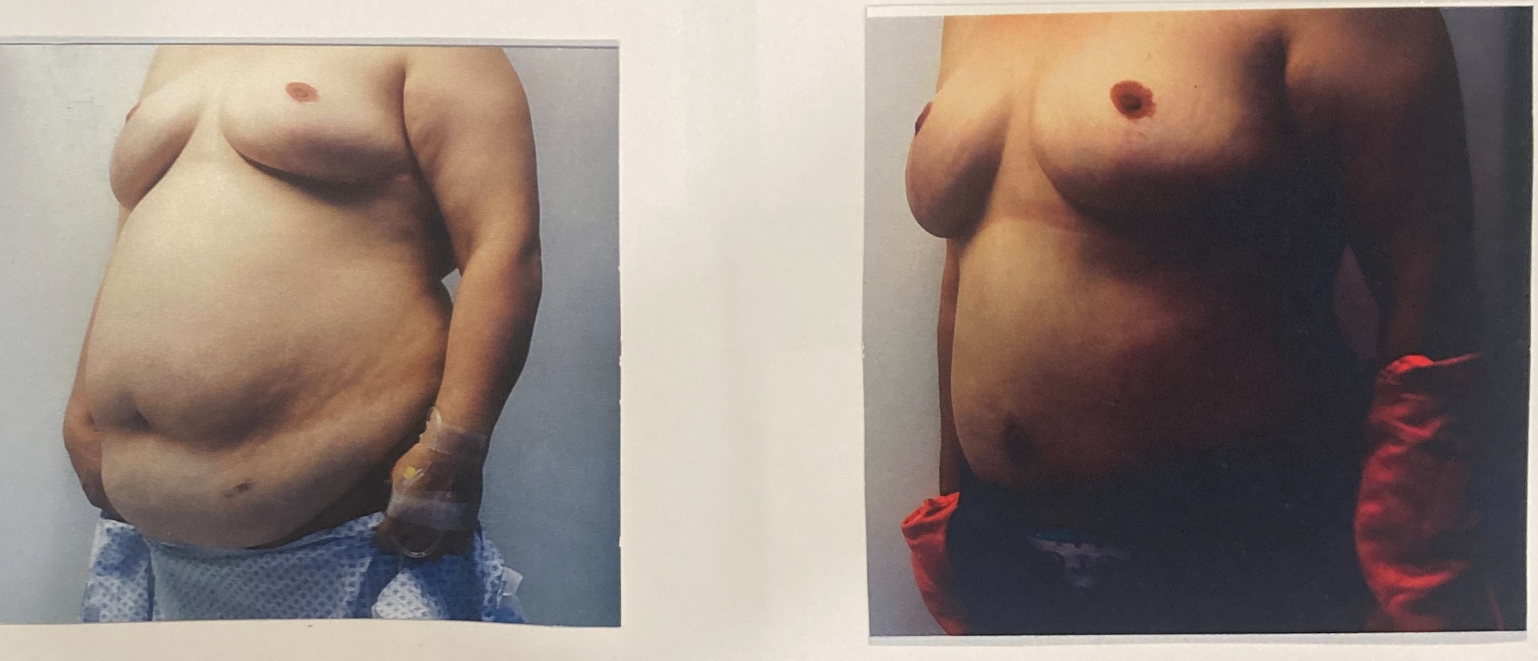 Before and After Image: Abdominoplasty with Liposuction - left-front-oblique