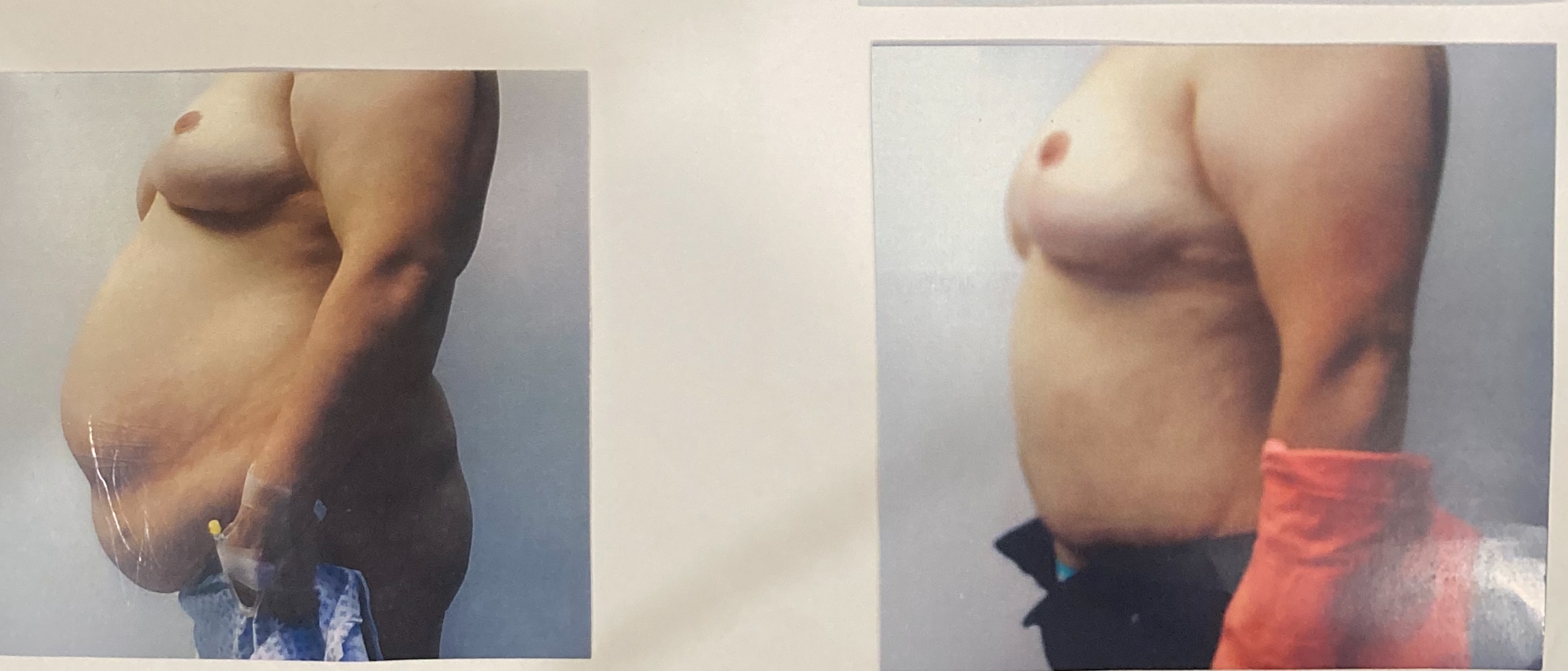 Before and After Image: Abdominoplasty with Liposuction - left-side