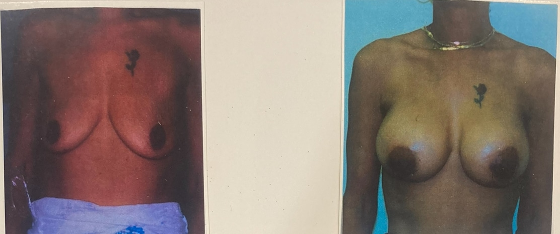 Before and After Image: Breast Augmentation