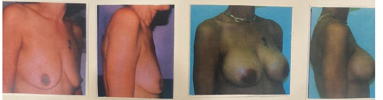Before and After Image: Breast Augmentation - right-front-oblique