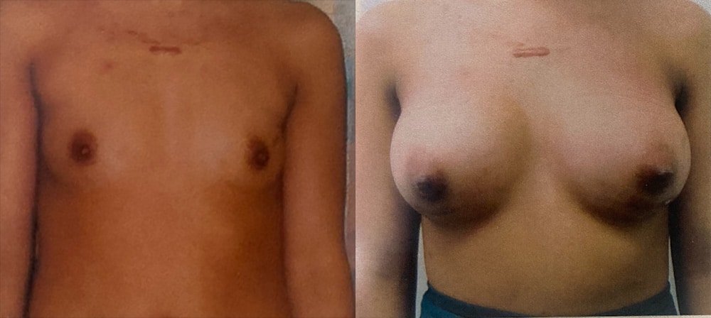 Before and After Image: Breast Augmentation - front
