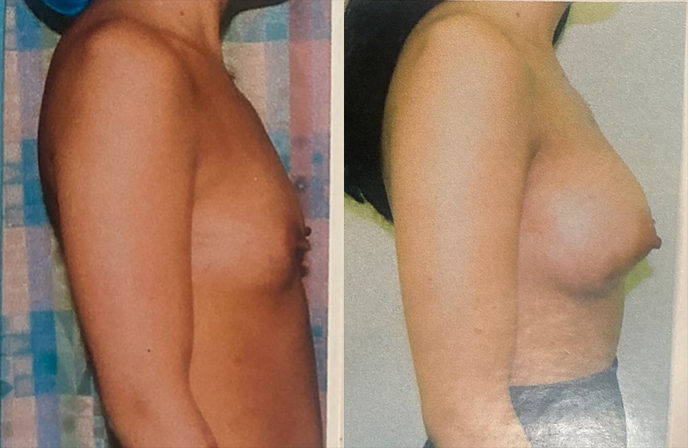Before and After Image: Breast Augmentation - right-side