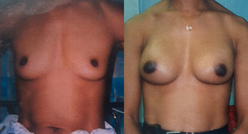 Before and After Image: Breast Augmentation - front
