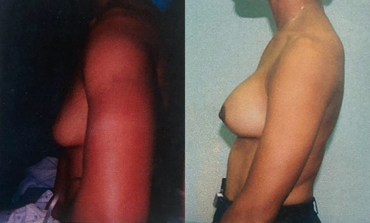 Before and After Image: Breast Augmentation - front