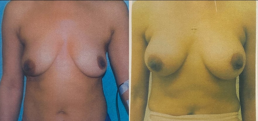 Before and After Image: Breast Augmentation - front
