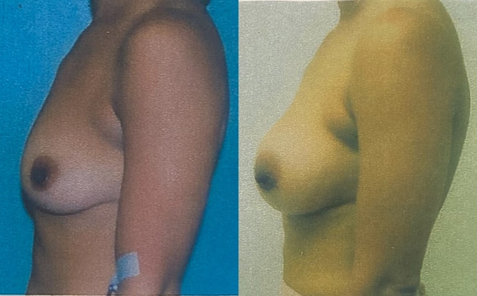 Before and After Image: Breast Augmentation - left-side