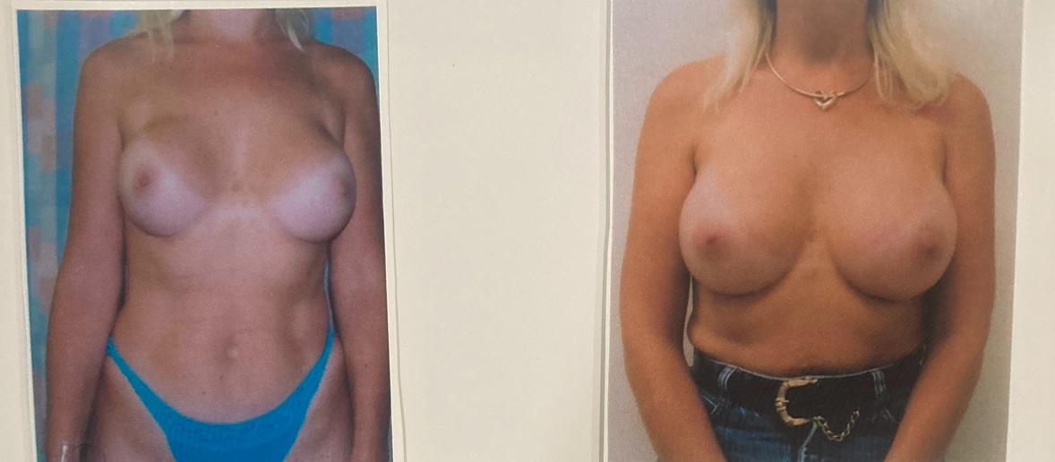 Before and After Image: Implant Removal and Breast Augmentation