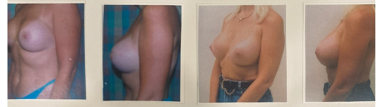 Before and After Image: Implant Removal and Breast Augmentation - left-front-oblique